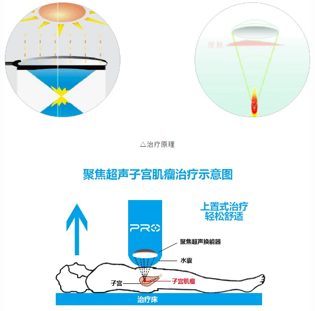 【人文妇科】非侵入性“微无创”治疗，到底好在哪里？_03.png